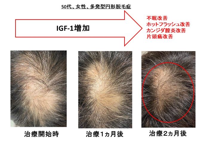 円形脱毛症　病院